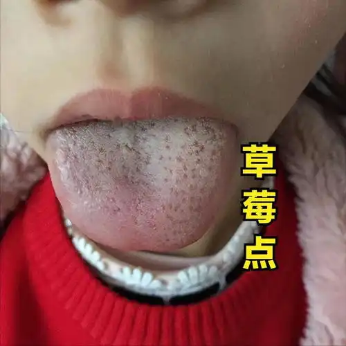 肝郁可大可小,中医教你从舌头舌象看肝郁的程度