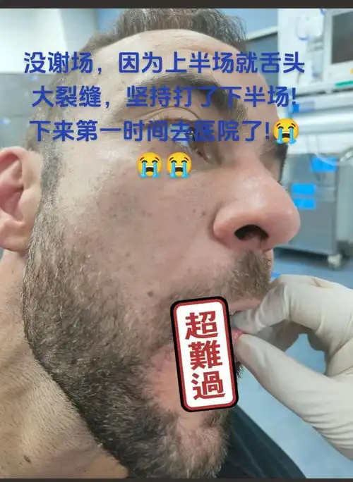 河南队官员解释科维奇没谢场上半场舌头裂缝,直接去医院了