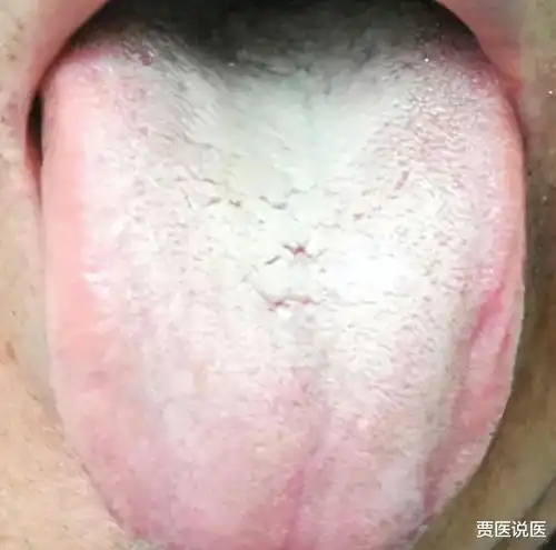 如果你也是这种白厚腻的舌苔,不妨了解一下这个中成药,一准没错