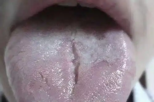 脾胃不好舌头开裂图片