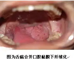 茶陵吃槟榔的快看下恰个槟榔不咯不了不了不了