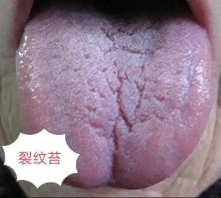 从舌头看健康,看看你是哪种问题舌