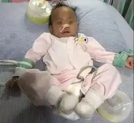一岁宝宝的胃被撑破,竟是因为妈妈给她吃了