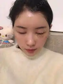 请叫我胖子小喵喵额头亮堂堂看没看到,我术前的时候...面部填充悦美整形