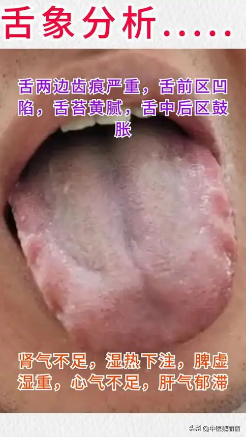 舌象挑战第11天,一舌一分析中气下陷,脾虚,肝气郁结,心气虚