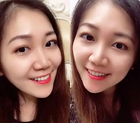 千万不要做舌侧矫正,做了你就会后悔怎么没有早点开始