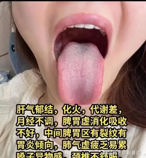 舌象实战分析中肝气郁结湿气重脾胃气虚阳虚