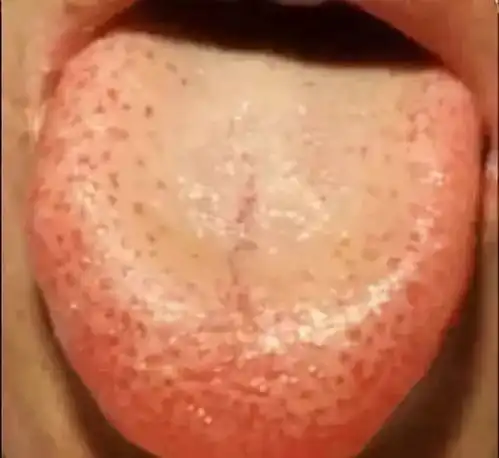 讲得最全的舌诊,值得收藏