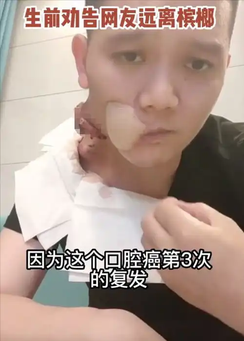 槟榔四巨头一天狂吃5包槟榔,两年死仨,剩下一个割舍保命