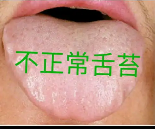 治疗早泄的根本在于舌苔的变化