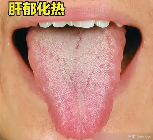 肝是哑巴器官当肝快出问题时,会出现这5种舌象,都应该知道