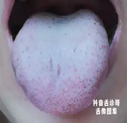 舌诊哥舌诊知健康,教你学会看舌象系列六十四