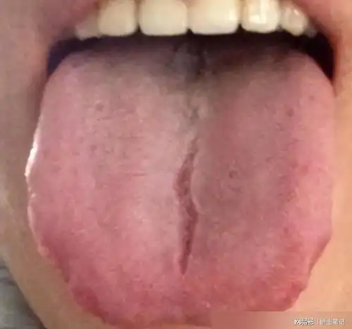 舌头有裂纹,可能不是脾虚,而是这里的问题,快来对照一下