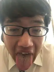舌苔发黄开裂是什么问题