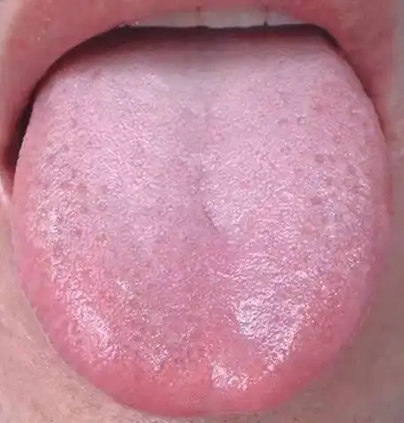 舌头中间有裂纹,或者边缘有齿痕等,是大病征兆教你几招快速舌诊