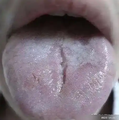 舌头有裂纹,可能不是脾虚,而是这里的问题,快来对照一下