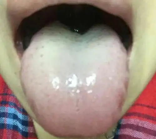 一个强力祛湿的中成药,舌苔白腻湿气重的人用得上