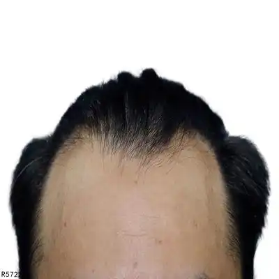 雄性激素性脱发可以吃哪些菜