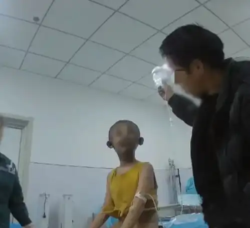 惨痛教训8岁熊娃玩火烧伤全脸监控曝光