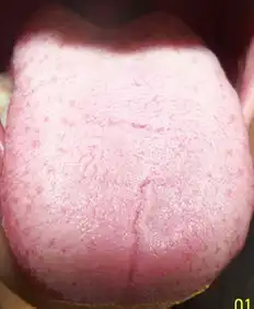请帮忙看下舌苔有图片