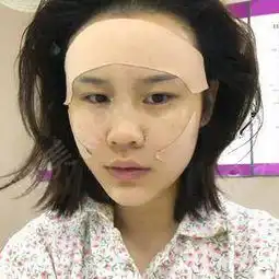 进了手术室后,先是给我大腿消毒,取的大腿内侧脂肪正...自体脂肪悦美整形