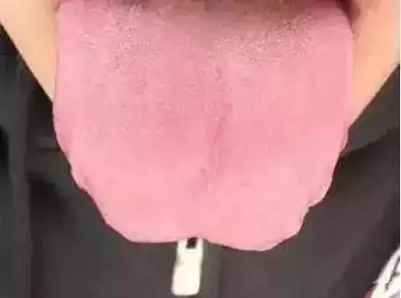 舌头是人体自带的体检表,一旦出现这个信号,就要小心了
