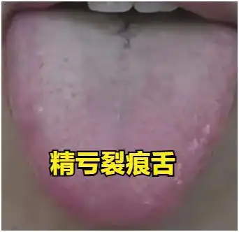 精亏裂痕舌五子衍宗,气血虚裂痕舌四物,阳虚裂痕舌真武,
