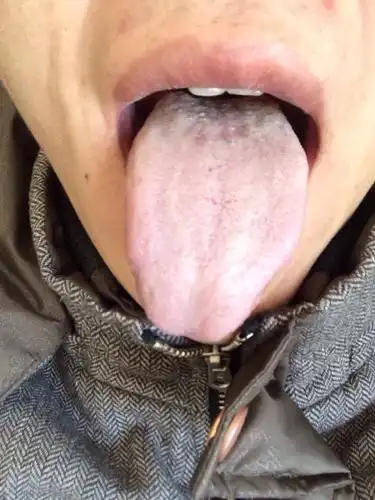 舌苔白厚怎么回事晚上睡觉前刷牙,但是早上起来舌头就一层白色东西,能用牙齿刮下来