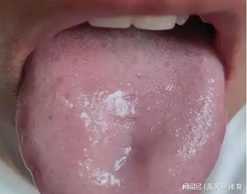 五脏有湿怎么办看看舌头就知道教你1招,把身上的湿气吸干净
