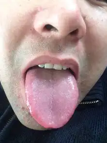 性功能时好时坏时有阳痿舌头中后部白腻嘴里总有唾液,舌边有齿痕大便粘腻不爽还有口干咽燥嗓