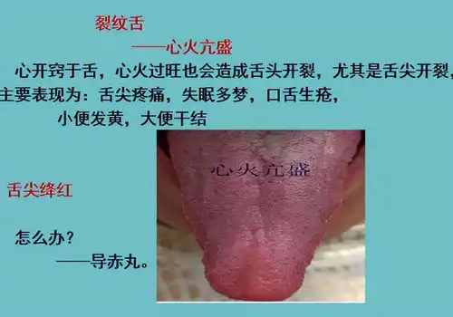 舌头有裂纹就是阴虚吗四种裂纹舌,十种舌象看看你是属于哪一种