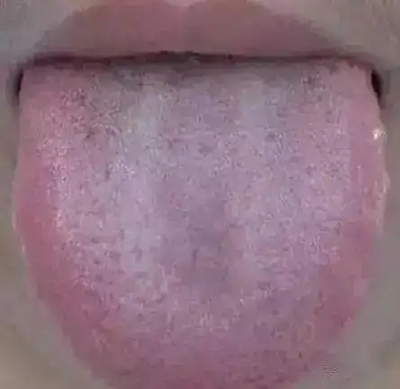 舌头,一旦出现这个信号,马上去医院