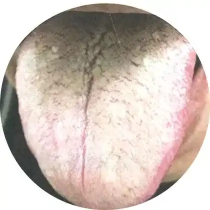 中医望诊望舌诊断三