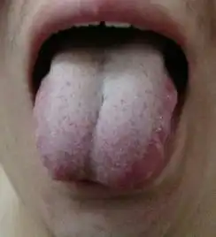 懂中医的,请看我舌头图,是否有正常要怎么调理
