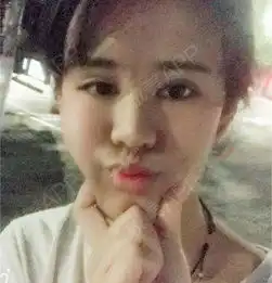 因为第7天拆线还是有点肿,所以过着两天在发图片,拆...垫鼻尖悦美整形