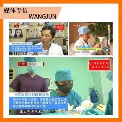 异体骨隆鼻王军院长生物微创隆鼻异体骨隆鼻不取骨鼻孔内隐形切口速享美挺翘鼻悦美整形
