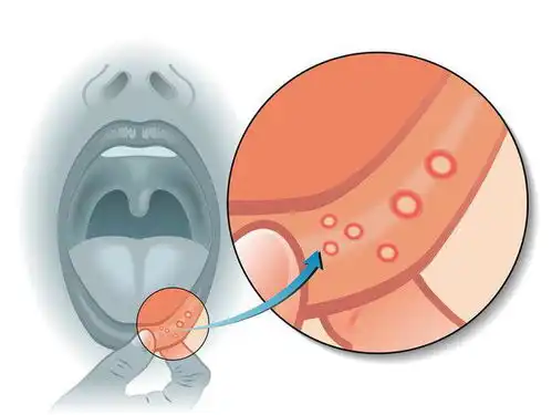 体内有癌,嘴巴先知口腔若出现3种迹象,可能是癌症来临的警报